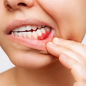 Gum disease is an infection of the gums by oral bacteria