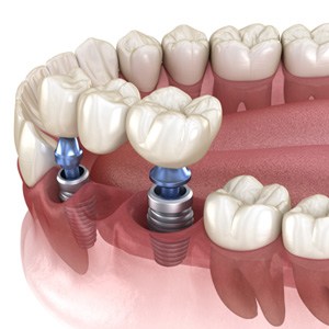 An example of a implanted dental bridge from South Ridge Dental