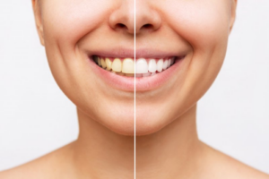 Before/after of a teeth whitening treatment